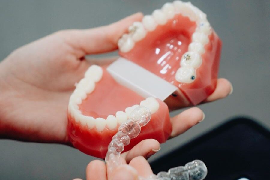 Aligner Aligner-Behandlung – transparente Zahnschiene